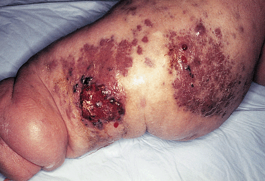 John Libbey Eurotext - European Journal of Dermatology - Lymphangiosarcoma  of Stewart-Treves