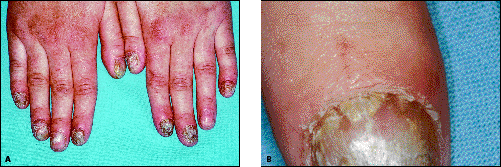 John Libbey Eurotext - European Journal of Dermatology - Autoimmune  polyglandular syndrome (APS) type 1 and candida onychomycosis