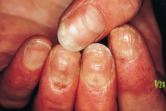 John Libbey Eurotext - European Journal of Dermatology - Lichen planus of the nails and fingertips John Libbey Eurotext - European Journal of Dermatology - Lichen planus of the nails and fingertips