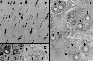 John Libbey Eurotext European Journal Of Dermatology Contrast Enhanced Phototrichogram Ce Ptg An Improved Non Invasive Technique For Measurement Of Scalp Hair Dynamics In Androgenetic Alopecia Validation Study With Histology After