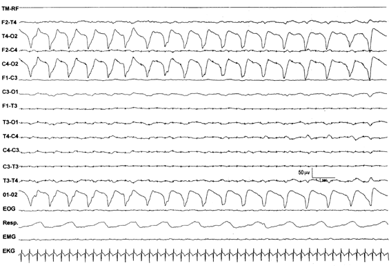 eeg seizure eeg seizure