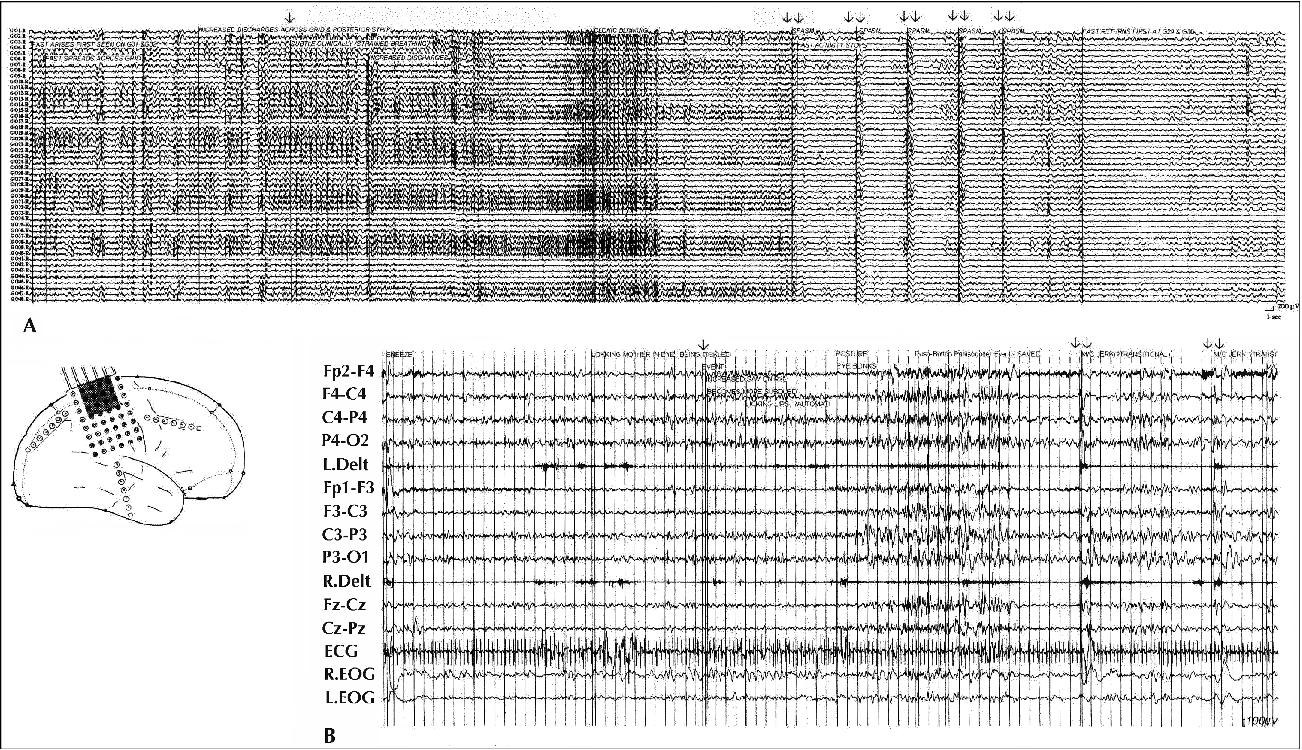 John Libbey Eurotext Epileptic Disorders Epilepsy And Malformations Of The Cerebral Cortex