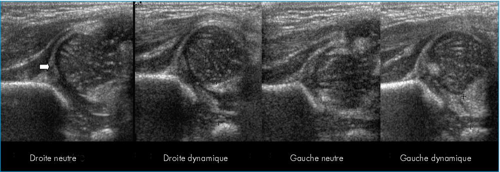 John Libbey Eurotext Medecine Therapeutique Pediatrie L Echographie Dans La Luxation Congenitale De Hanche