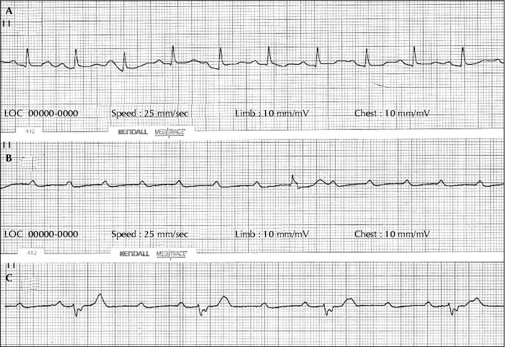 John Libbey Eurotext Epileptic Disorders Unrecognized Paroxysmal Ventricular Standstill Masquerading As Epilepsy A Stokes Adams Attack