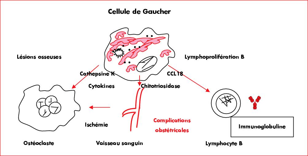 Maladie De Gaucher; deficit en beta-glucocerebrosidase; maladie de ...