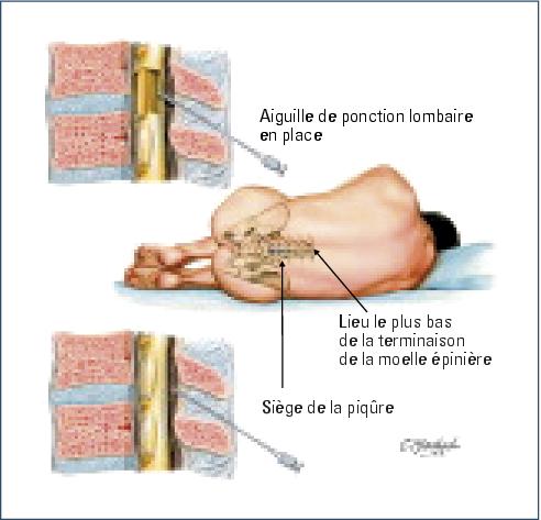 ponction lombaire