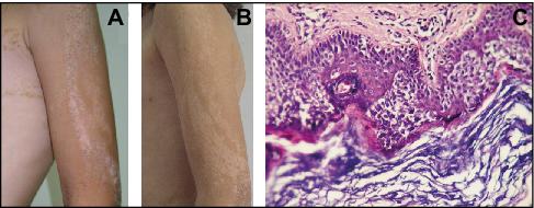 papillomatosis epidermis)