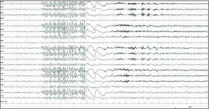 eeg seizure pattern eeg seizure pattern