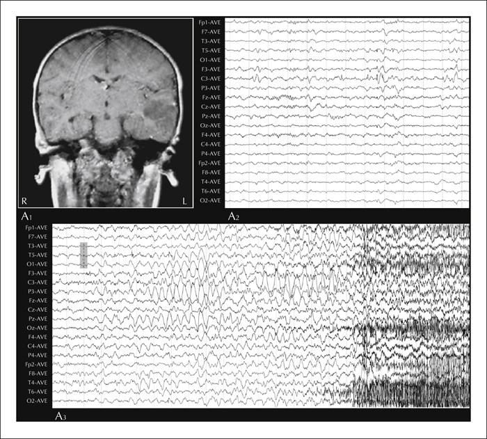 John Libbey Eurotext Epileptic Disorders Extratemporal Surface Eeg Features Do Not Preclude Successful Surgical Outcomes In Drug Resistant Epilepsy Patients With Unitemporal Mri Lesions