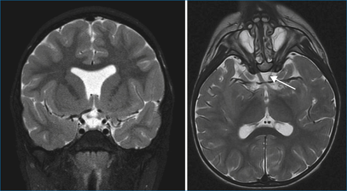 John Libbey Eurotext Medecine Therapeutique Pediatrie Imagerie Des Pathologies Malformatives Sus Tentorielles