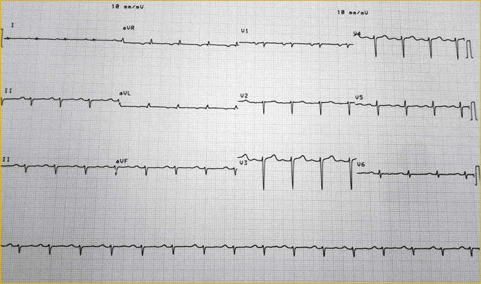 John Libbey Eurotext Medecine Et Sante Tropicales Atypical Left Ventricular Hypertrophy Revealing A Rare Cause Of Heart Failure In A Man From The Comoros Islands