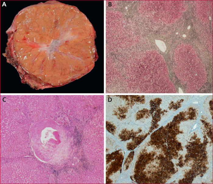 JLE - Hépato-Gastro & Oncologie Digestive - Tumeurs bénignes du foie