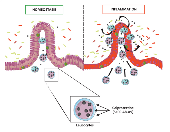 Intérêt de la calprotectine dans les maladies inflammatoires