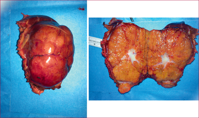 JLE - Hépato-Gastro & Oncologie Digestive - Tumeurs bénignes du ...