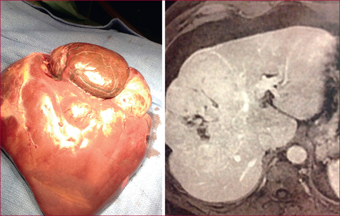 JLE - Hépato-Gastro & Oncologie Digestive - Tumeurs bénignes du ...