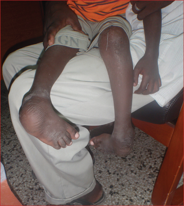 John Libbey Eurotext Medecine Et Sante Tropicales Traitement Du Pied Bot Varus Equin Idiopathique Mise En Place De La Methode Ponseti Dans Un Pays Emergent John Libbey Eurotext Medecine Et Sante Tropicales Traitement Du Pied Bot Varus Equin Idiopathique Mise En Place De La Methode Ponseti Dans Un Pays Emergent