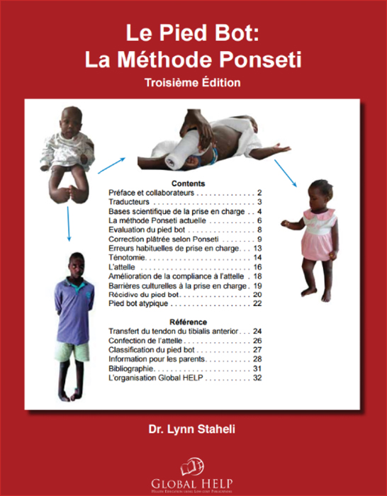 John Libbey Eurotext Medecine Et Sante Tropicales Traitement Du Pied Bot Varus Equin Idiopathique Mise En Place De La Methode Ponseti Dans Un Pays Emergent