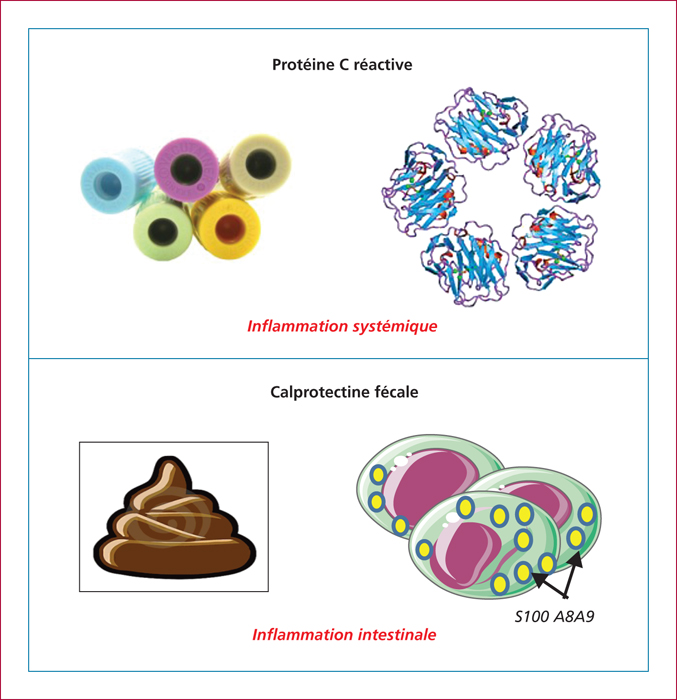 PDF Intérêt de la calprotectine dans les maladies inflammatoires PDF ...