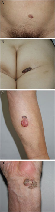 hpv bowen disease