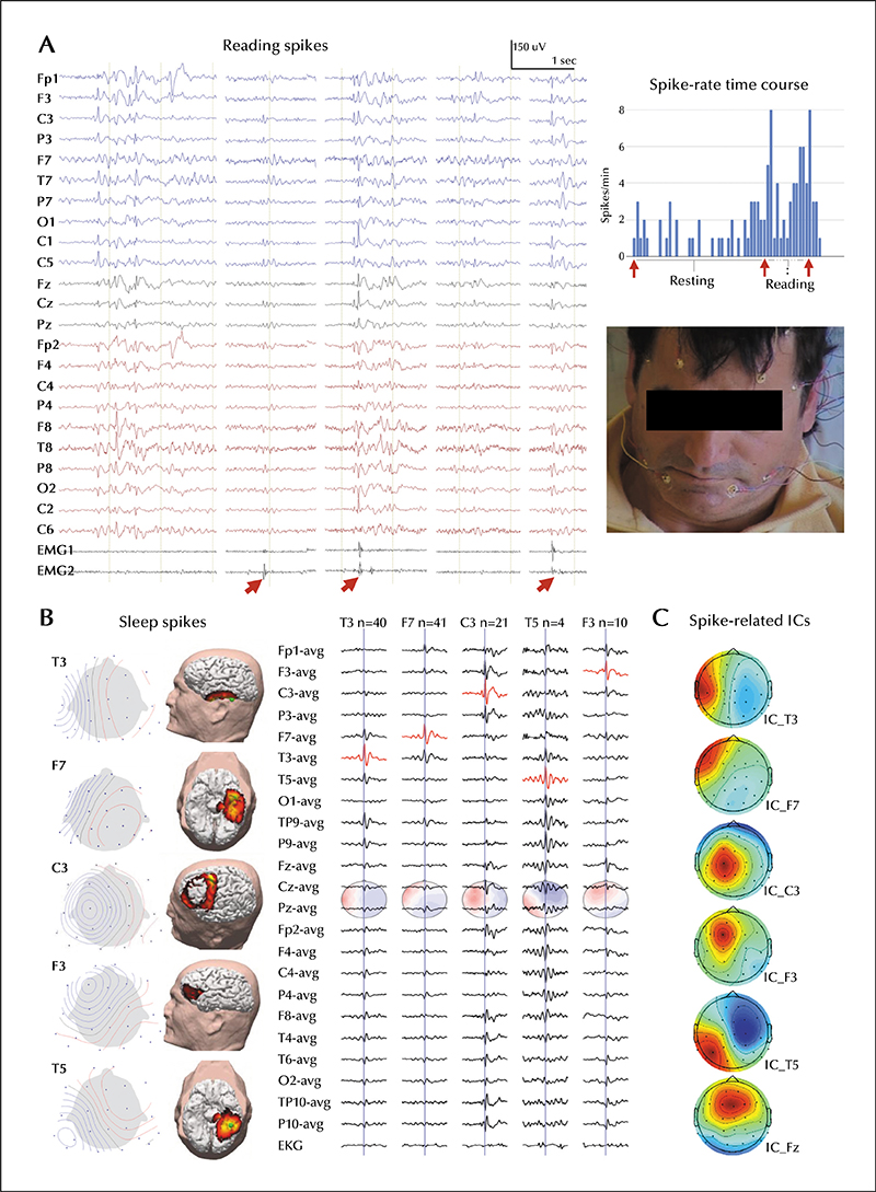 John libbey eurotext epileptic disorders visual word form area